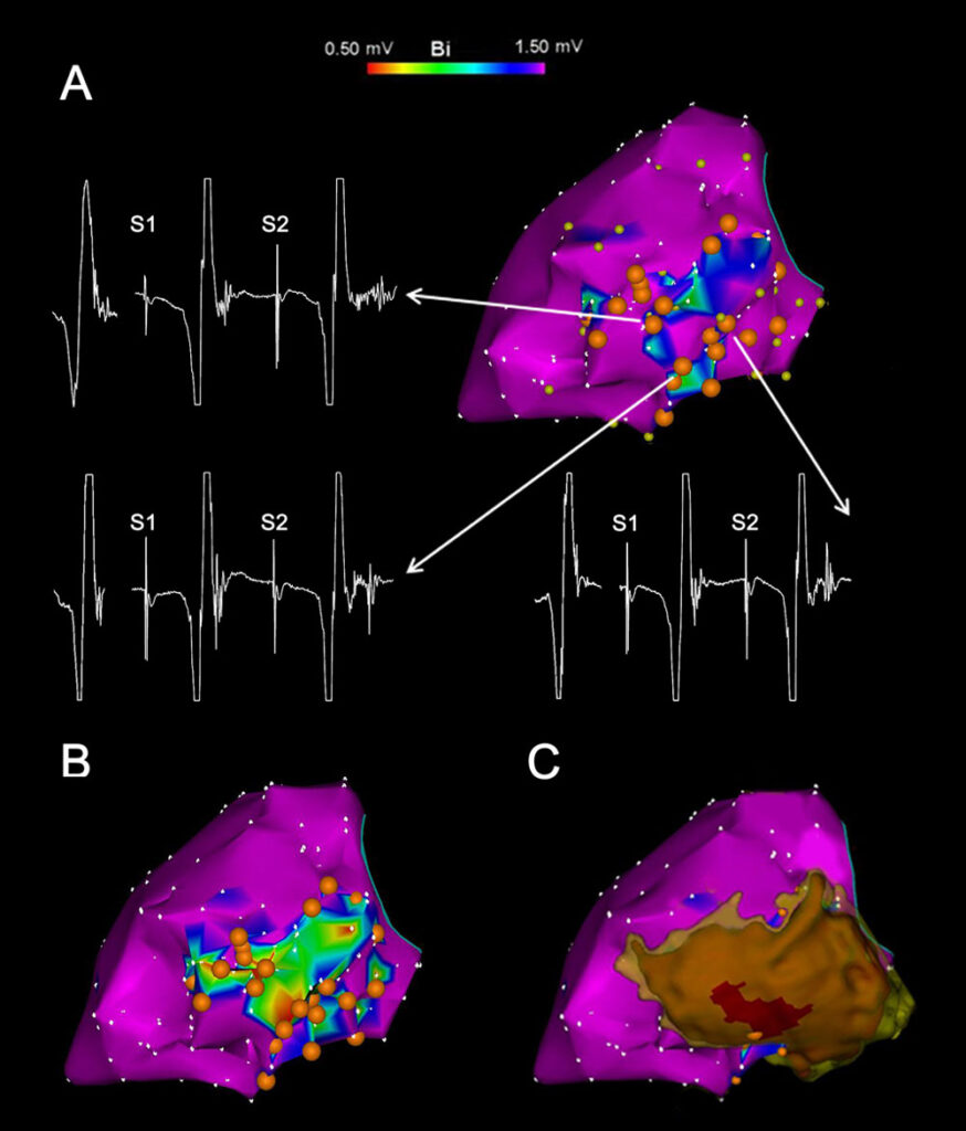 project functional substrate mapping and ablation for post infarct vt wecam