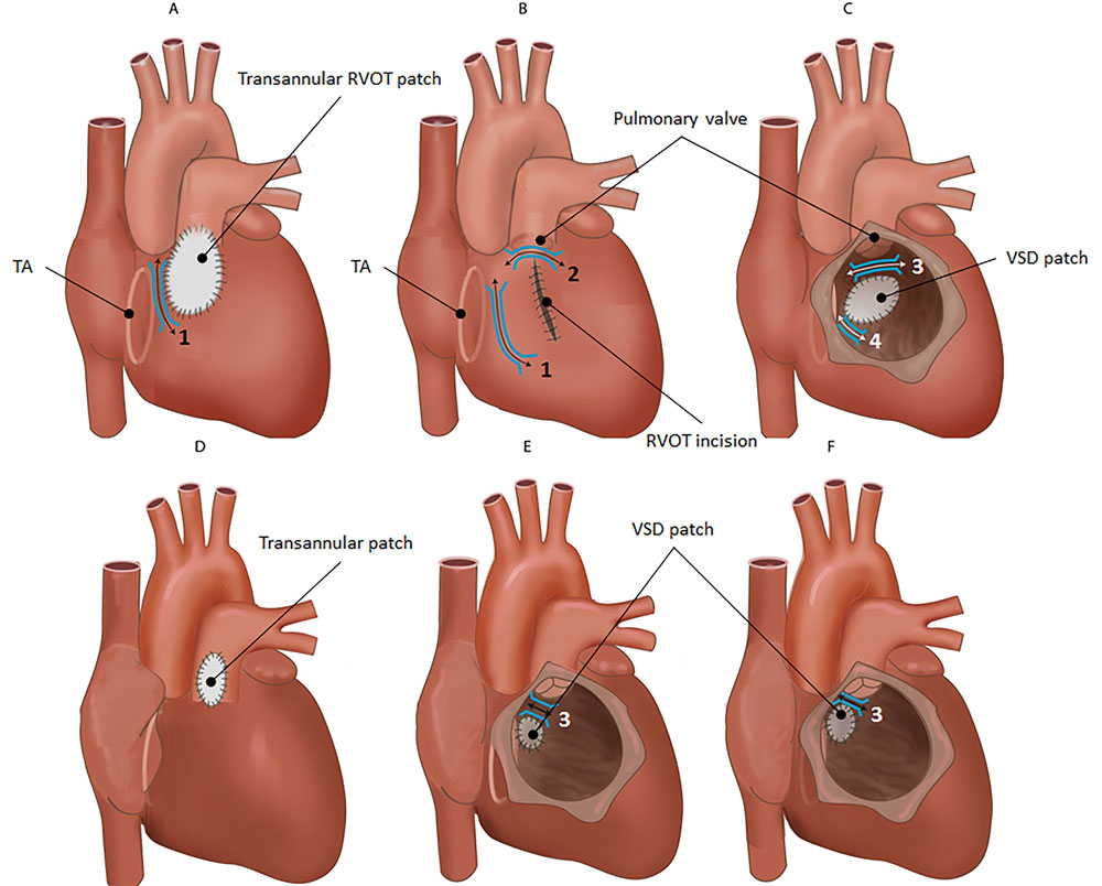 project towards the curative treatment of vt in congenital heart disease wecam